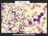 H κυτταρομορφολογία στη διάγνωση των αιματολογικών διαταραχών