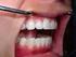- όταν ο ασθενής ασκεί έντονες μασητικές πιέσεις (κατά τη μάσηση, τρίξιμο ή σφίξιμο των δοντιών κ.α.). - όταν υπάρχουν συγκλεισιακά προβλήματα.