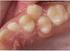 Ετεροτοπία δοντιών στην άνω γνάθο μεταξύ κυνόδοντα και πλάγιου τομέα. Αναφορά τριών κλινικών περιπτώσεων