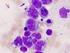 Acute promyelocy-c leukemia: where did we start, where are we now and the future