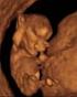 Tρισδιάστατη (3D) υπερηχοκαρδιογραφία στο έμβρυο
