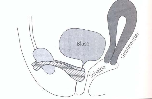 Tension free mid-urethral slings retropubic transobturator vag.-abd.