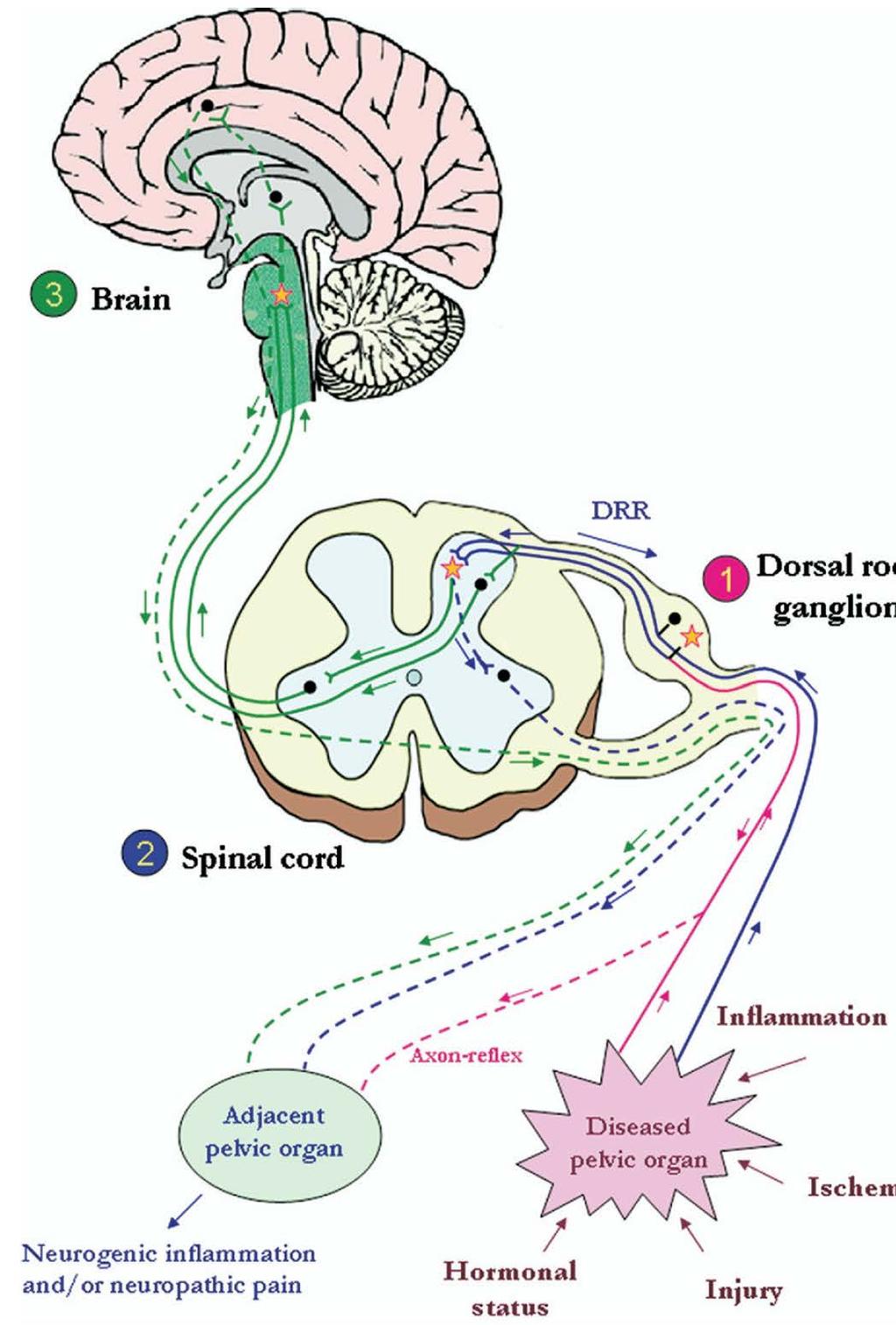 Δομικές αλλαγές κυστικού τοιχώματος - νεύρων Υπάρχει αύξηση του μεγέθους Προσαγωγών νευρώνων στα οπίσθια νωτιαία γάγγλια Αύξηση προσαγωγών ώσεων Αλλοδυνία -