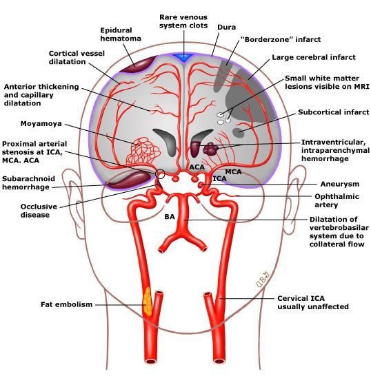 Cerebrovascular complications with their