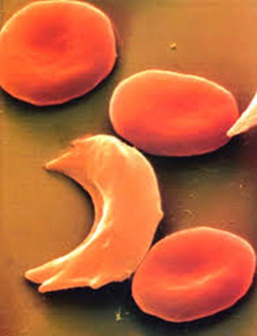 Δρεπανοκυτταρική νόσος μορφές ομόζυγη δρεπανοκυτταρική αναιμία μικτά ετερόζυγα δρεπανοκυτταρικά σύνδρομα π.χ.