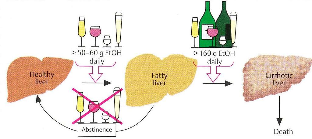 Ηπατική βλάβη από αιθανόλη -Liver damage Ανώτερα επιτρεπτά όρια για άρρενες 60 g ημερησίως, και για γυναίκες 50 g Σε