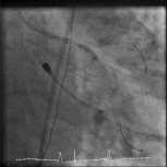 5x20), Cutting Balloon (3.0x10mm) 4. Stenting LCx, LAD : Promus E. (2.