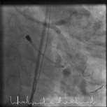 LM stenting (Xience 4.0x33mm).