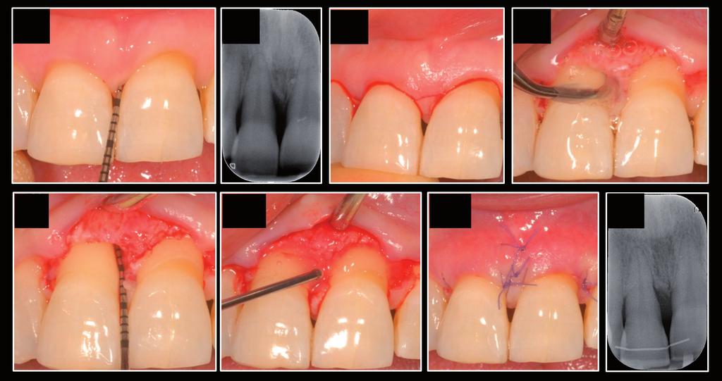 L. Trombelli: «Απλοποιημένες διαδικασίες περιοδοντικής αναγέννησης» L. Trombelli: Simplified procedures for periodontal regeneration 17 Α/A B/B Γ/C Δ/D Ε/Ε ΣΤ/F Ζ/G H/H Εικόνα 1.