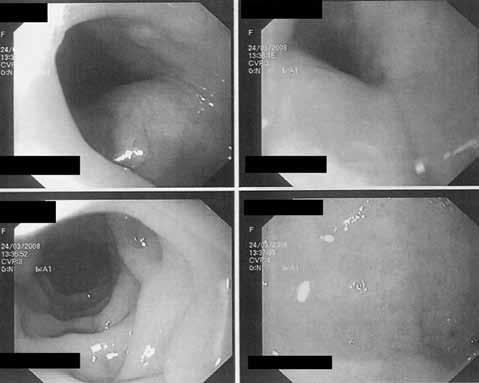 HELLENIC SURGΙCAL ONCOLOGY, Vol. 1, Number 3, September - December 2010 131 Πίνακας 1. Κλινική συμπτωματολογία, αποτελέσματα διαγνωστικών εξετάσεων και χειρουργική προσπέλαση.