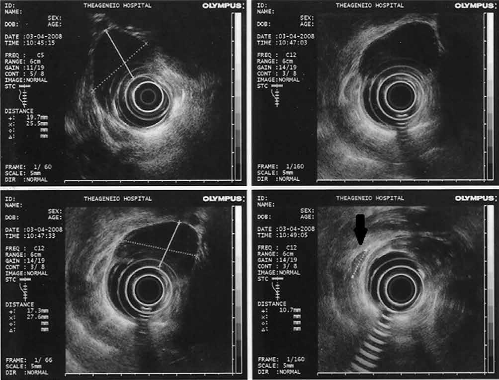 132 ΕΛΛΗΝΙΚΗ ΧΕΙΡΟΥΡΓΙΚΗ ΟΓΚΟΛΟΓΙΑ, Τόμος 1ος, Τεύχος 3ο, Σεπτέμβριος - Δεκέμβριος 2010 Εικόνα 2. Ενδοσκοπικό υπερηχογράφημα οισοφάγου.