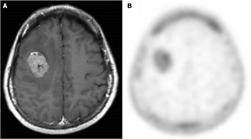 [ 18 F]FLT PET : Newly diagnosed grade IV