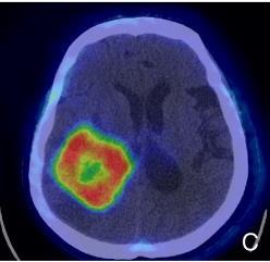11 C-Choline PET/CT: αναγνωρίζει
