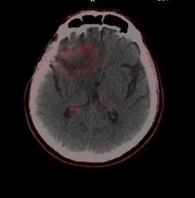 18 F-Choline