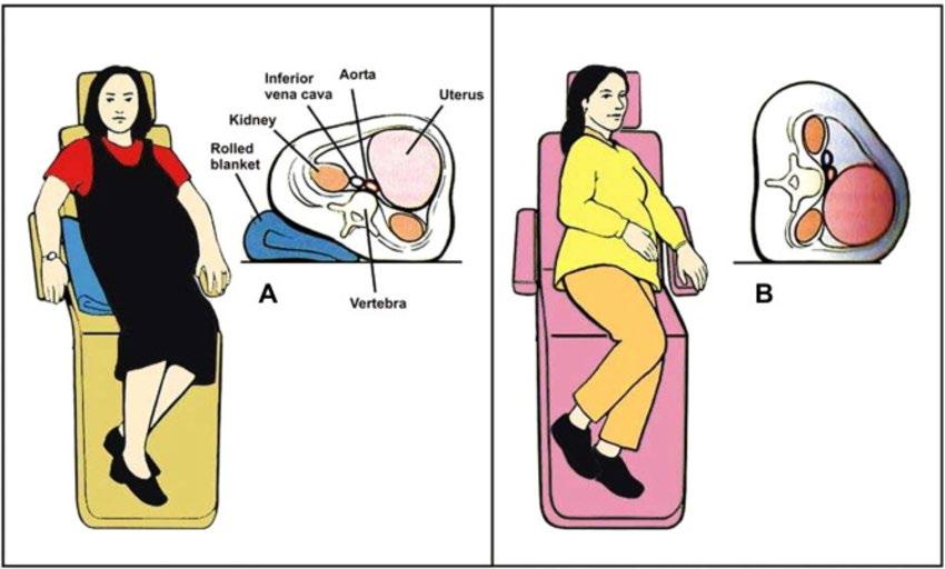 ΕΠΕΙΓΟΥΣΕΣ ΚΑΤΑΣΤΑΣΕΙΣ ΣΤΗΝ ΑΛΛΕΡΓΙΟΛΟΓΙΑ ΑΝΤΙΜΕΤΩΠΙΣΗ ΣΑ- ευάλωτοι ασθενείς Έγκυες γυναίκες: τοποθετούνται στο αριστερό πλάϊ, ώστε να μην πιέζει η μήτρα την κάτω κοίλη φλέβα εμποδίζοντας την ροή του