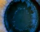 Αποφολιδωτικό Γλαύκωμα (ΓΑ) στην Ελλάδα Σημαντικό πρόβλημα η συχνή παρουσία ΓΑ Η Thessaloniki Eye Study κατέγραψε αποφολίδωση στο 11.