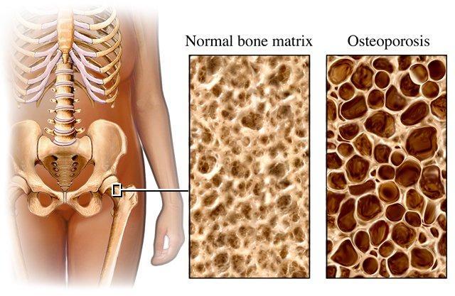 Οστεοπόρωση Σκελετική διαταραχή που χαρακτηρίζεται από μειωμένη οστική