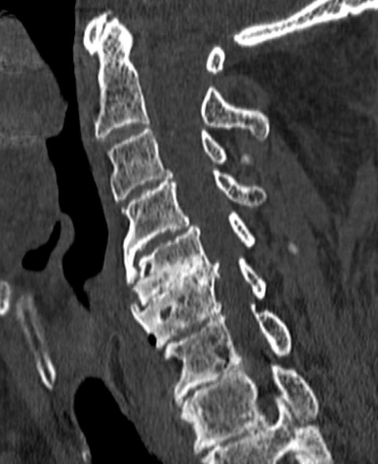 Forrestier s disease) Οστική υπερπαραγωγή σε καταφύσεις συνδέσμων