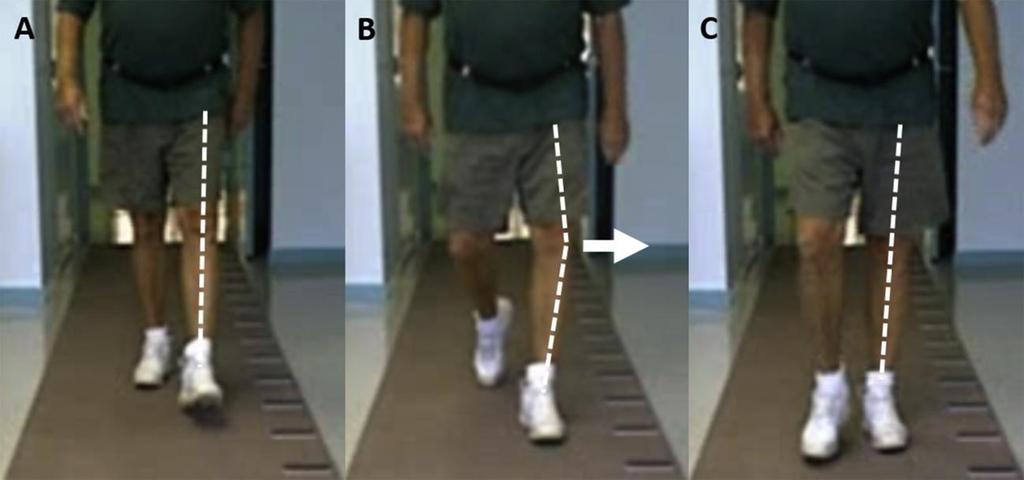 ΠΧΣ έξω μετατόπιση γόνατος (varus thrust) Walking with a varus thrust increases the
