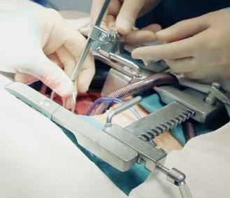 Τοποθέτηση Bolling Retractor Βήμα 1 Προσαρτήστε το Mini L-Bar στο τμήμα με