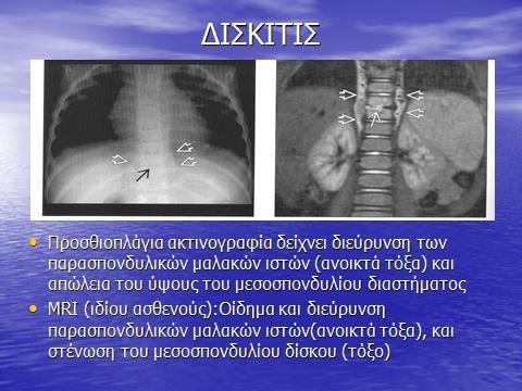 Οστεομυελίτιδα σπονδύλου Συμβαίνει σε παιδιά συνήθως μεγαλύτερα των 8 ετών και εφήβους.