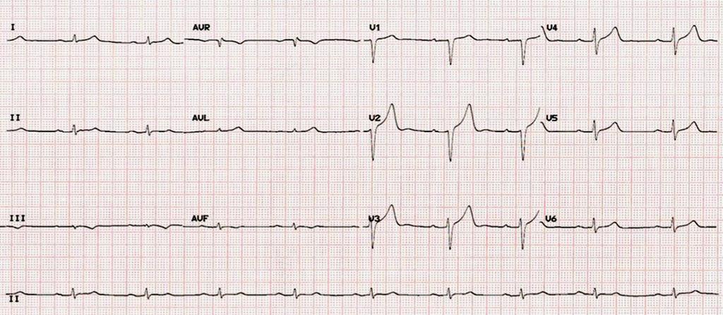 AL AMYLOIDOSIS reduced voltage in 46 60% (28% in our department), atrial fibrillation in 20%, pseudo-infarct pattern TTR