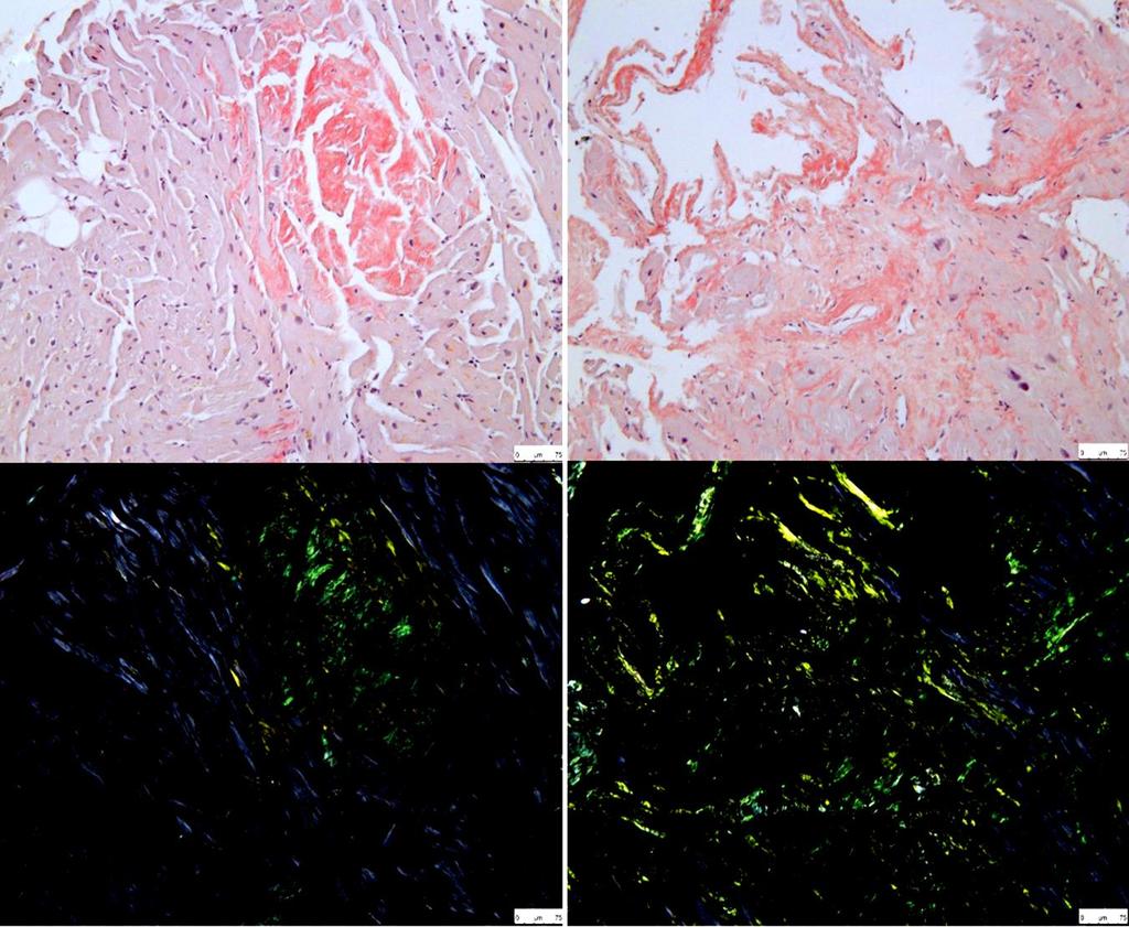 ΒΙΟΨΙΑ ΠΕΡΙΦΕΡΙΚΩΝ ΟΡΓΑΝΩΝ Abdominal fat aspirate with Congo red staining 70 90% sensitive for AL but 15 45% for TTR.