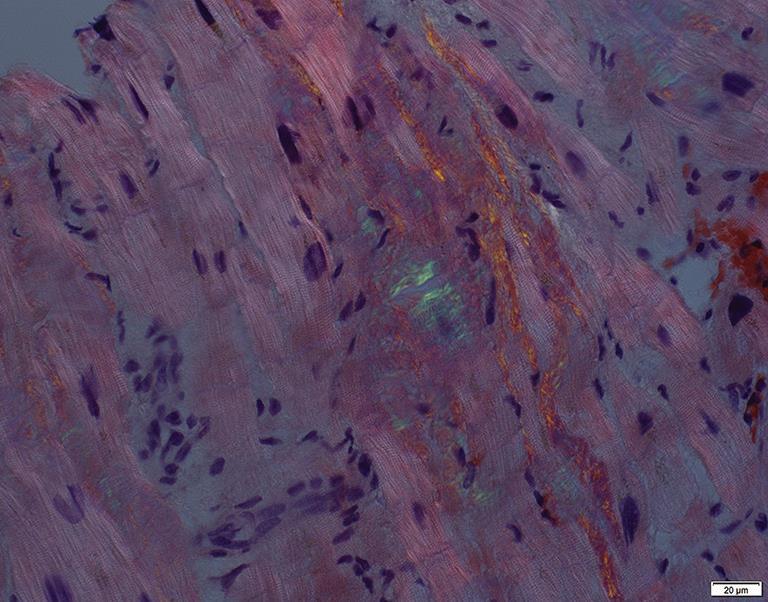 ΒΙΟΨΙΑ Abdominal fat aspirate with Congo red staining 70 90% sensitive for AL but 15 45% for TTR.