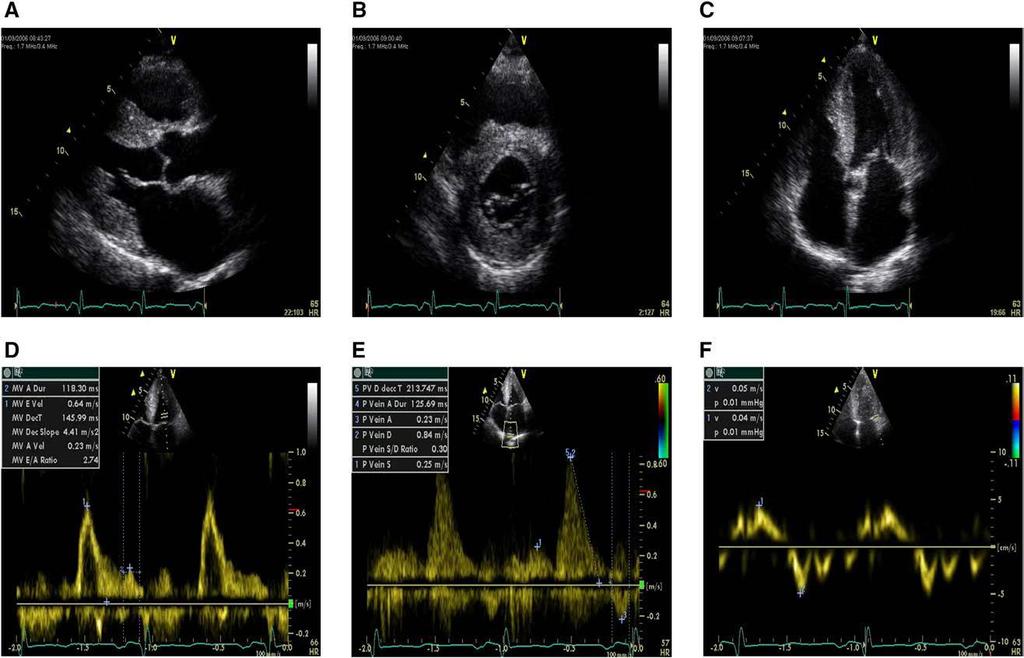 Concentric left ventricular hypertrophy, bright myocardium,bi-atrial dilatation, Increase in E/A ratio, pulm vein inflow: marked diastolic prominence and