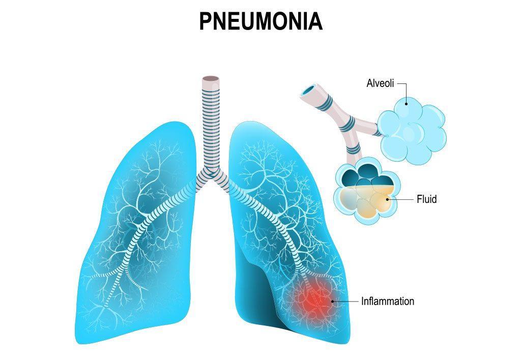 1. Σοβαρή Πνευμονία από την Κοινότητα (Severe Community-Acquired Pneumonia, scap) Πνευμονία από την κοινότητα