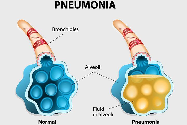 2. Νοσοκομειακή Πνευμονία (Hospital Acquired Pneumonia, HAP) Πνευμονία που εμφανίζεται 48
