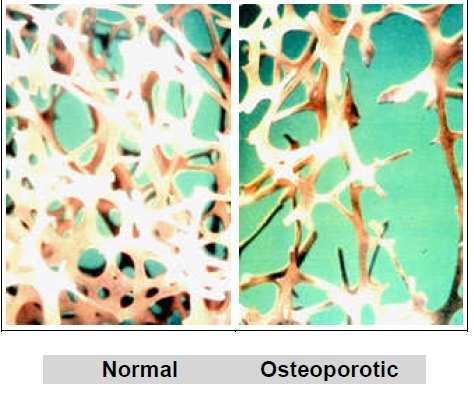 Ορισμός Οστεοπόρωση είναι η σκελετική διαταραχή που χαρακτηρίζεται από χαμηλή οστική μάζα και απώλεια της