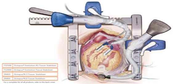 OFF-PUMP CABG VS ON-PUMP CABG ΣΕ ΧΝΑ ΤΕΛΙΚΟΥ ΣΤΑΔΙΟΥ Σε συνολικά 13.085 αιμοκαθαιρόμενοι από τη βάση δεδομένων USRDS όπου οι 2.335 (17.