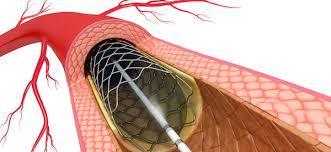 ΛΟΓΟΙ ΜΗ ΙΚΑΝΟΠΟΙΗΤΙΚΩΝ ΑΠΟΤΕΛΕΣΜΑΤΩΝ ΜΕ PCI Πολυπλοκότητα αλλοιώσεων στα στεφανιαία Διάχυτη νόσος