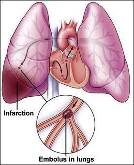 οξεία απόφραξη του πνευμονικού αρτηριακού δικτύου ΤΥΠΟΙ ΠΕ