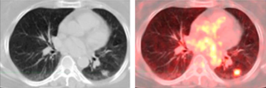 PET-CT sensitivity: 87-96% (SPN >8-10 mm) specificity: 79-83% PPV: 72% - 3 στους 10 ασθενείς με PET(+) SPN δεν έχουν κακοήθη SPN NPV: 90-92% - δυνατότητα