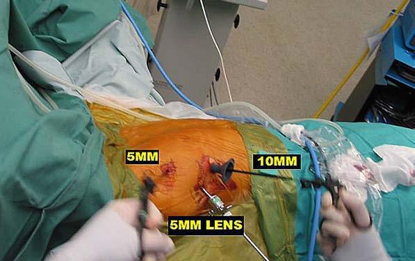 Video-Assisted Thoracoscopic Surgery ελάχιστα επεμβατική χειρουργική τεχνική: γενική αναισθησία ιατρογενής πνευμοθώρακας trocar (7o ΜΠΔ) - είσοδος θωρακοσκοπίου εντοπισμός SPN - σφηνοειδής εκτομή