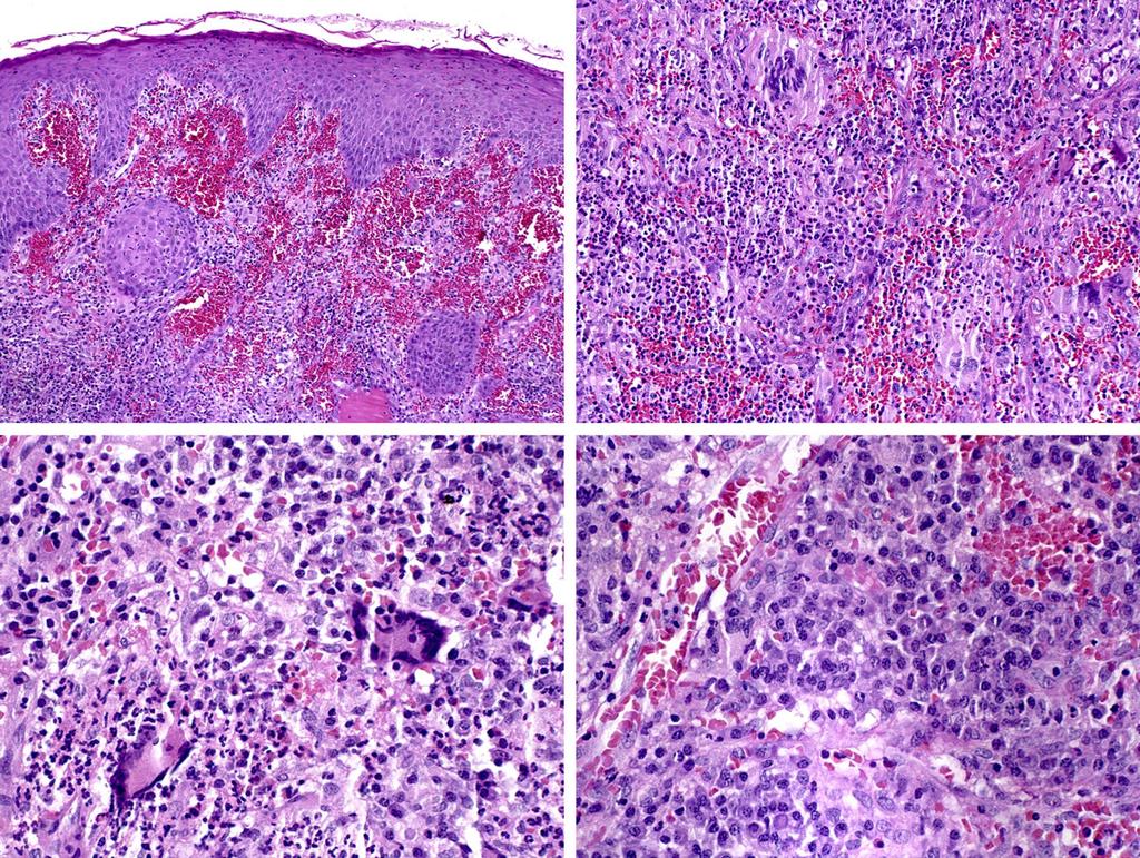 FP Fonseca et al. (c) (d) Fig. 2 Histological aspect of the gingival lesion. (A) Small foci of pseudoepitheliomatous proliferation were found (haematoxylin eosin (HE), original magnification 9100).