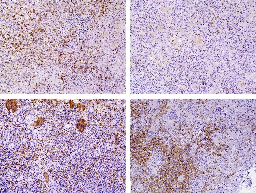 Gingival granulomatosis with polyangiitis (c) (d) Fig. 3 Immunohistochemical reactions (streptavidin biotin 3,3 0 -diaminobenzidine-tetrachloride, original magnification 9200).