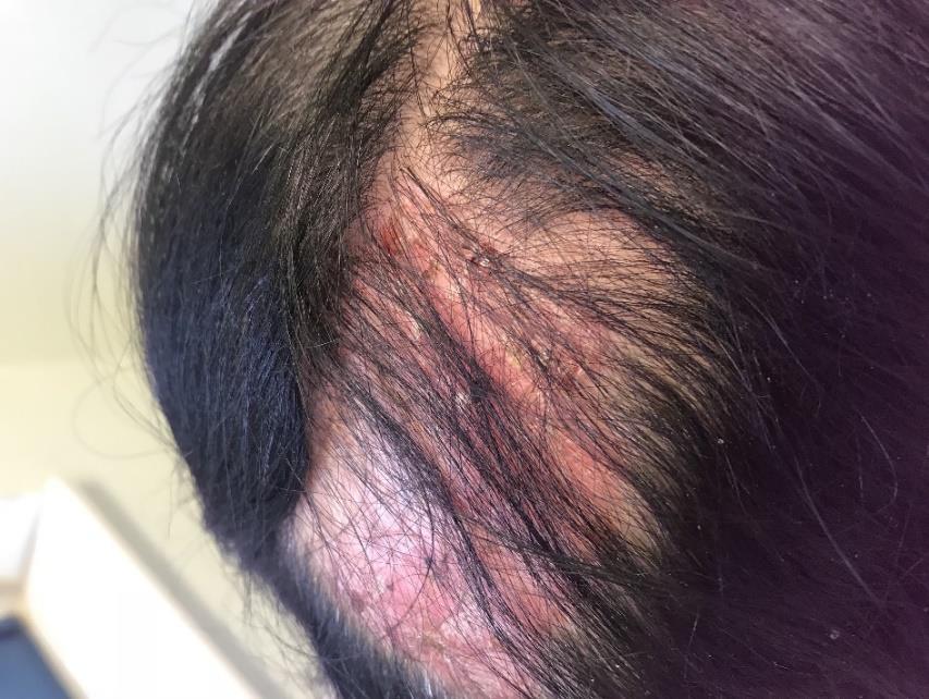03/2018 ΕΠΙΔΕΙΝΩΣΗ 05/2018 Stop HCQ MTX 20mg/wk s.c.