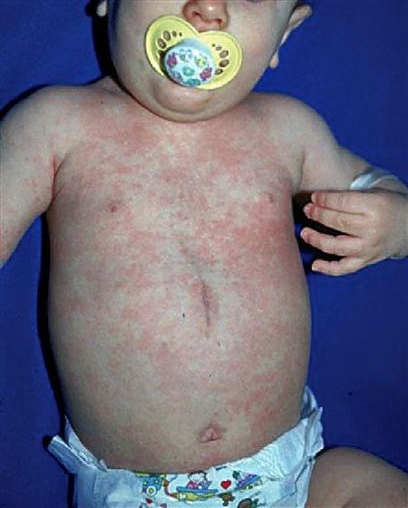 Roseola infantum ή