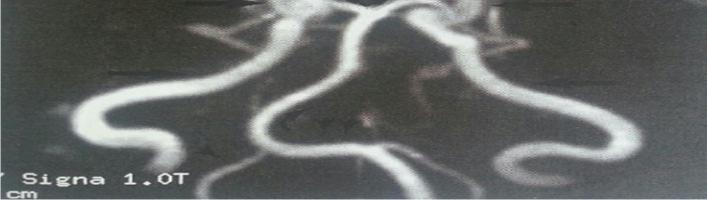 3 Μαγνητική αγγειογραφία (MRA) Η µαγνητική αγγειογραφία,(εικόνα 12) 29 είναι µια µέθοδος απεικόνισης των αιµοφόρων αγγείων µέσω µαγνητικού συντονισµού.
