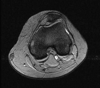 Παρατίθενται οι ακολουθίεσ : T1 coronal χωρίσ fat sat, T1 με καταςτολή λίπουσ πριν και μετά ςκιαγραφικό και Τ2 χωρίσ και με καταςτολή λίπουσ.