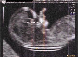 Έμβρυο με υποδόρια συλλογή υγρού στον αυχένα - Αυχενική διαφάνεια. Εικόνα 2.