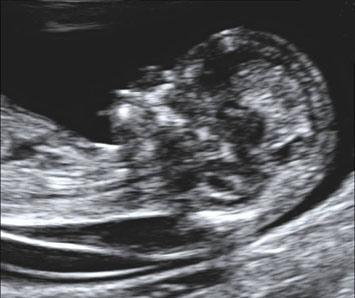 Εικόνα 3. Υπερηχογραφική εικόνα εμβρύου 12 εβδομάδων με τρισωμία 21, με αυξημένη αυχενική διαφάνεια και απουσία ρινικού ιστού.
