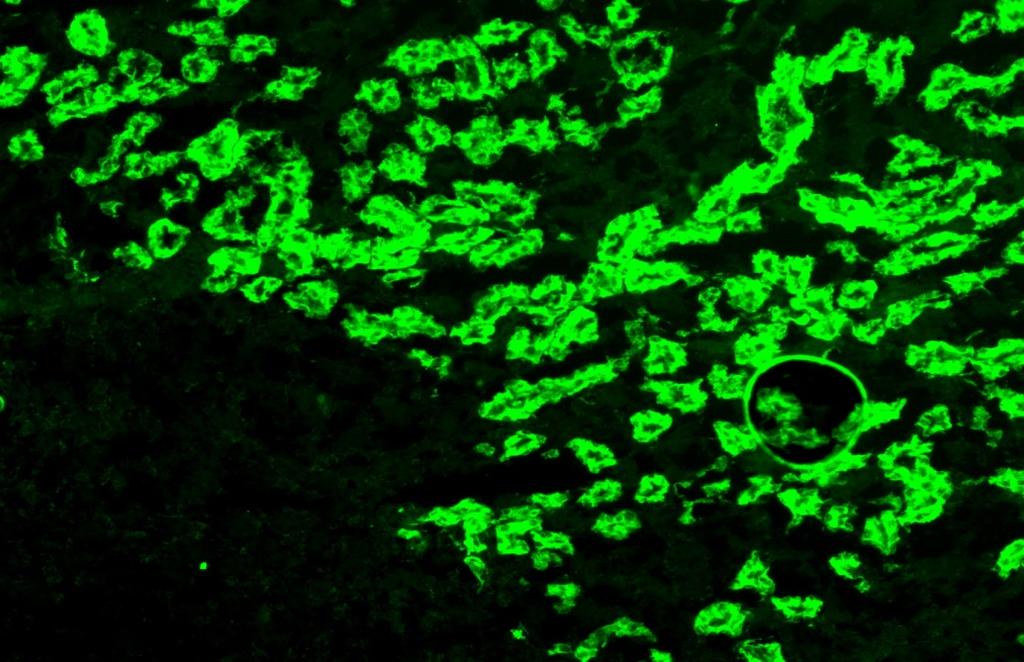 Epstein-Barr virus infection in a