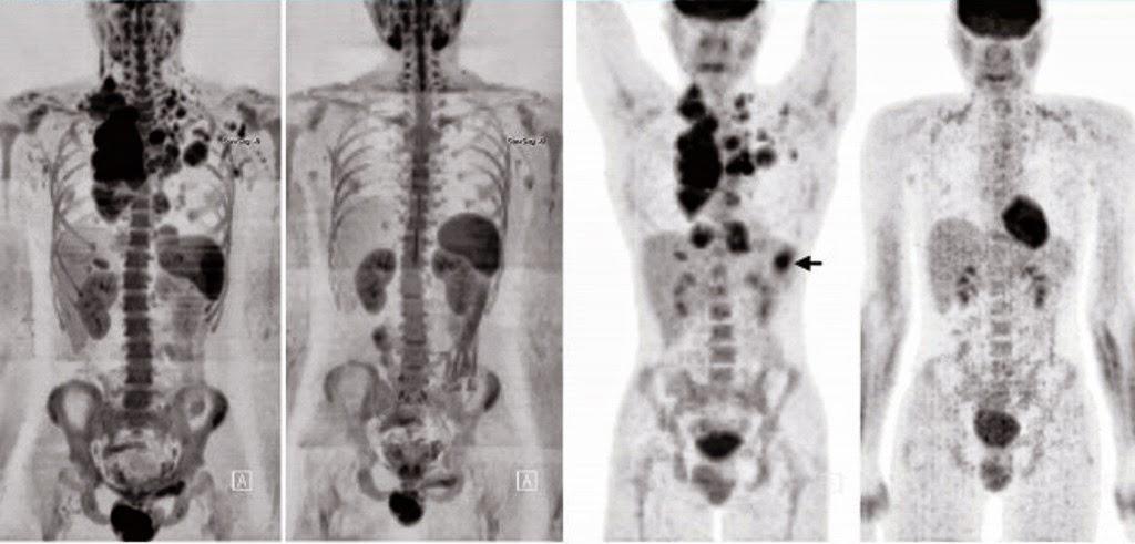 DWIBS MRI 92% / 88% - PET / CT 85% /