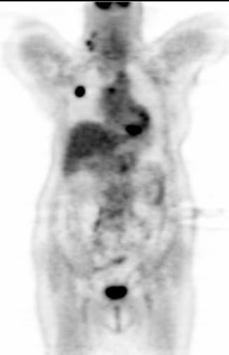 PET-CT