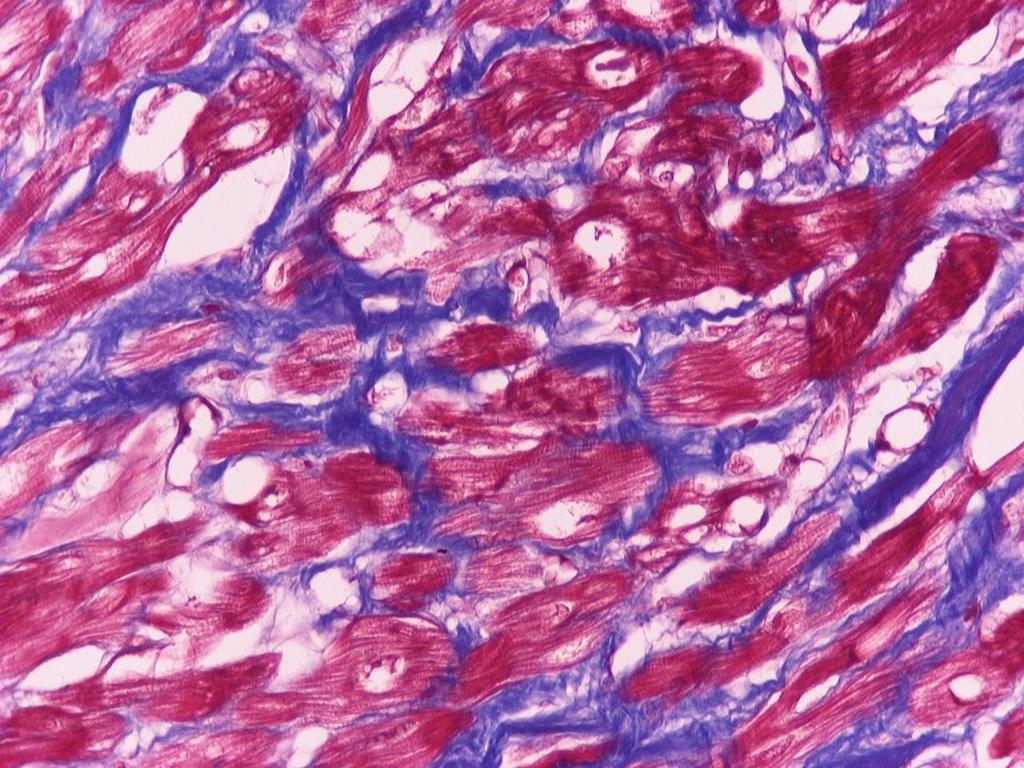 Cell hypertrophy,cell disarray, Interstitial fibrosis(head