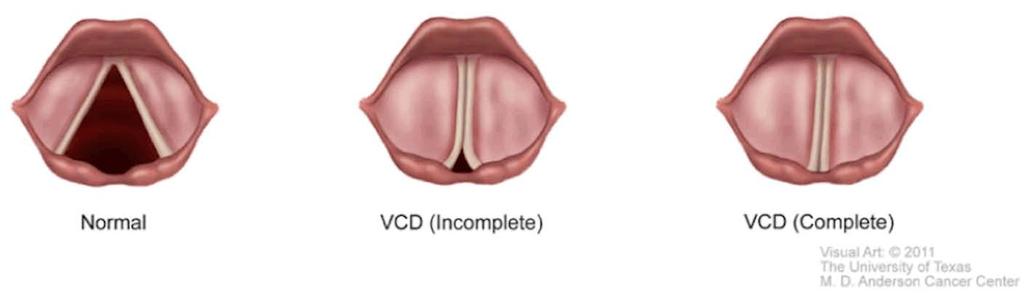 Vocal Cord Dysfunction (VCD) -Inducible Laryngeal obstruction ακούσια περιστασιακή σύγκλιση των φωνητικών χορδών στην εισπνοή Μπορεί να συνυπάρχει με βρογχ άσθμα: 3-5%